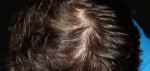 PRP For Thinning Hair Before